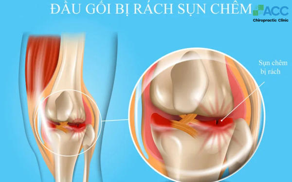 rách sụn chêm khớp gối