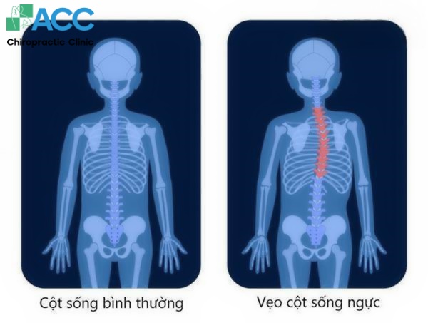 triệu chứng đau lưng giữa