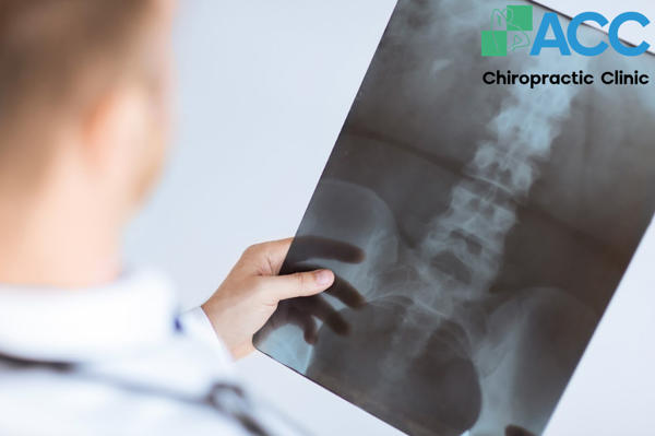 trượt đốt sống khi nào gặp bác sĩ