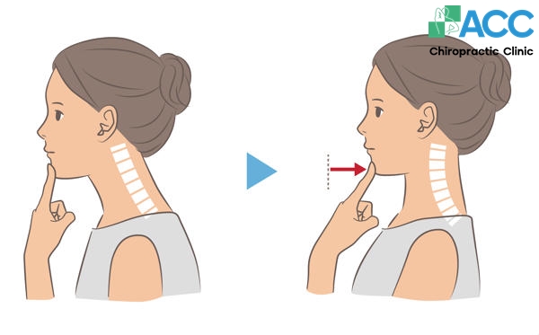 các bài tập chống gù lưng hiệu quả