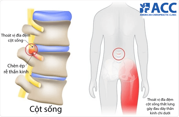 đau cột sống thắt lưng bắt nguồn từ tình trạng thoát vị đĩa đệm