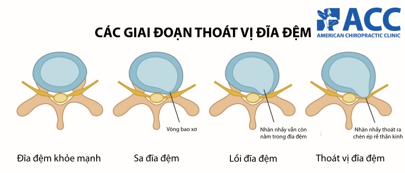 các giai đoạn thoát vị đĩa đệm