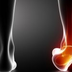 Bong gân mắt cá chân