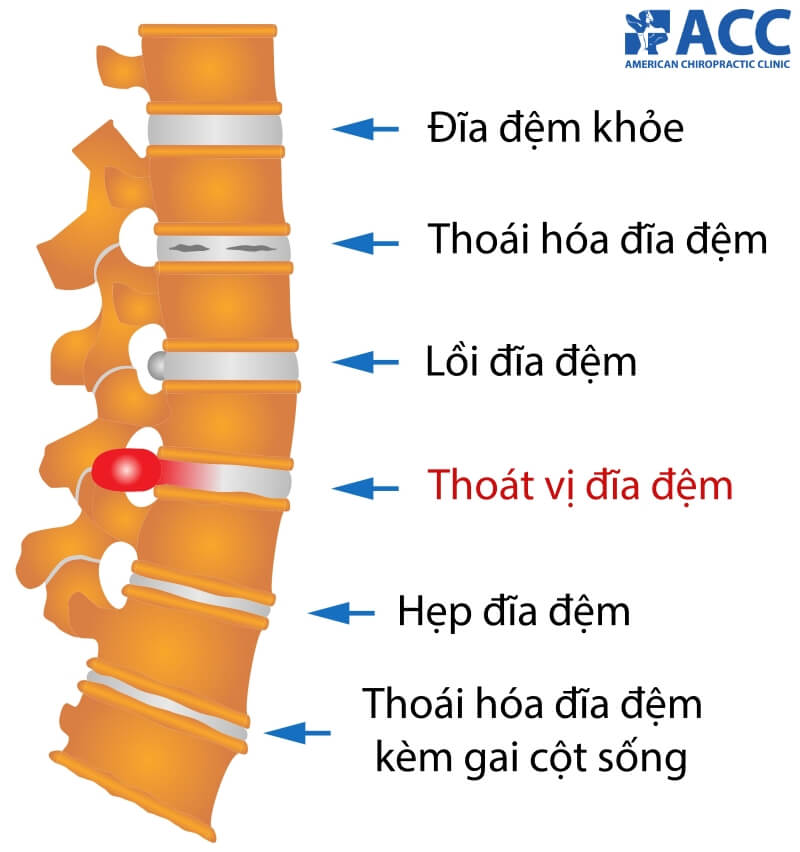 thoát vị đĩa đệm