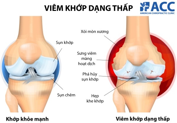  Viêm khớp dạng thấp : Những dấu hiệu bạn cần lưu ý