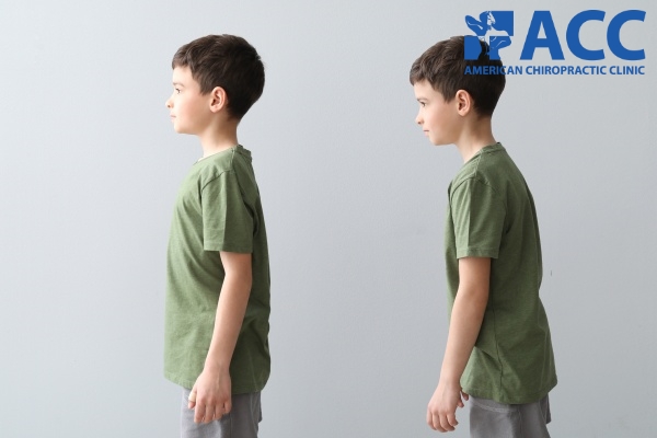 Nhận biết gù lưng ở trẻ từ sớm giúp tránh được những biến chứng nghiêm trọng