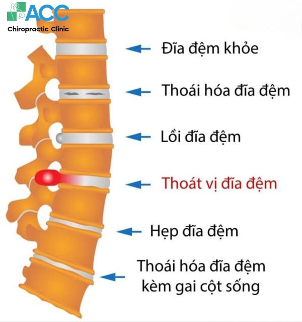 đau lưng mỗi gối