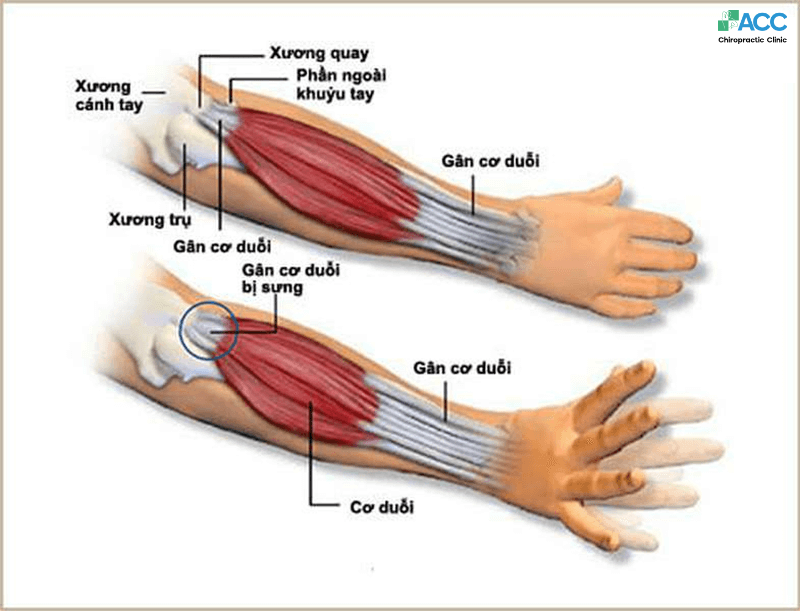 tình trạng viêm điểm bám gân khuỷu tay