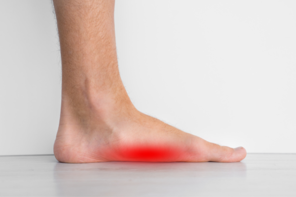Đau bàn chân khi chạy bộ có thể do hội chứng bàn chân bẹt