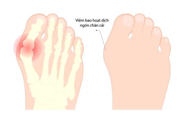 Viêm bao hoạt dịch ngón chân cái