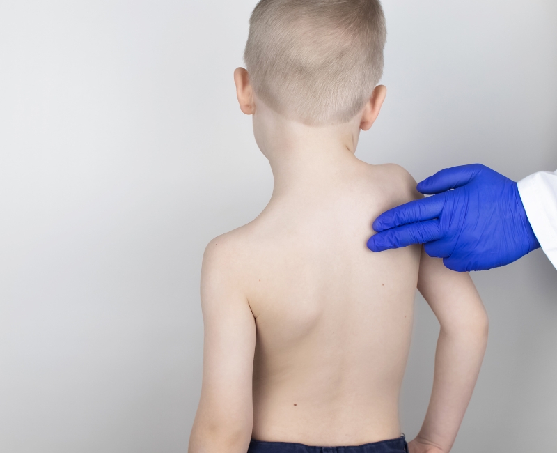 Trẻ em bị vẹo cột sống với sức đề kháng kém không nên can thiệp phẫu thuật