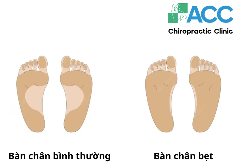 Sự khác nhau giữa bàn chân bình thường và bàn chân bẹt