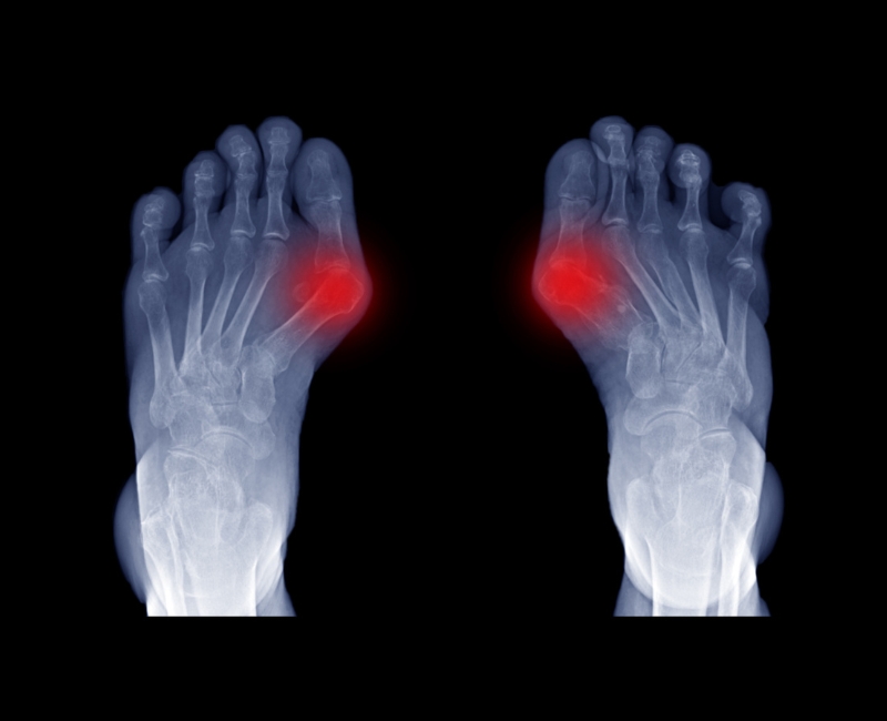 Bàn chân bẹt có thể dẫn đến bệnh lý viêm bao hoạt dịch ngón cái