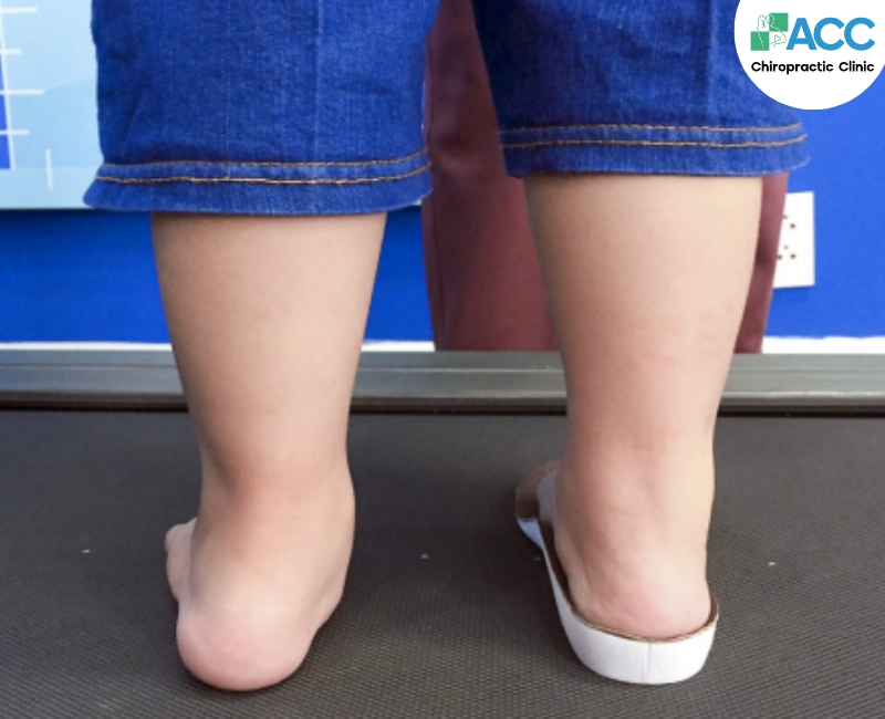 Bàn chân bẹt ở trẻ được cải thiện rõ rệt khi mang đế chỉnh hình
