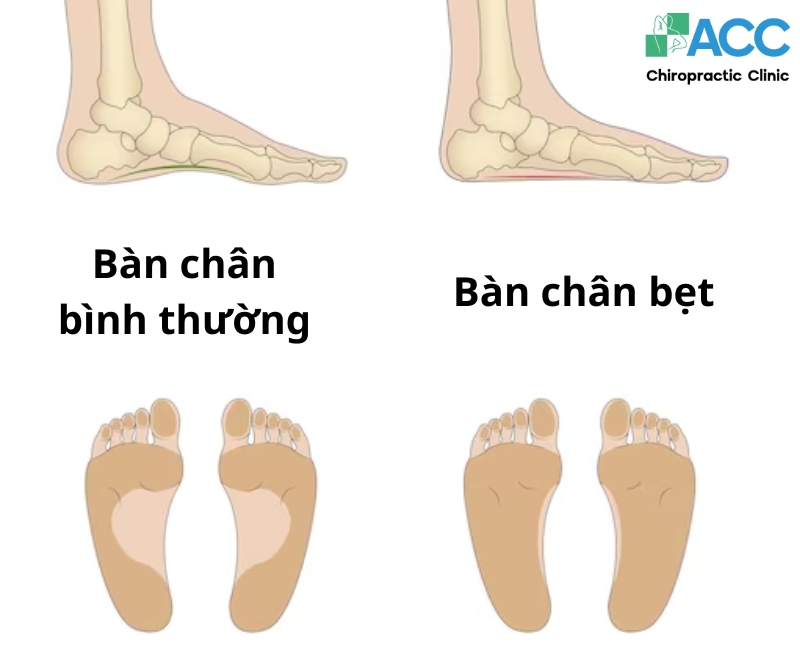 Bàn chân bẹt là tình trạng bàn chân không có hõm cong tự nhiên