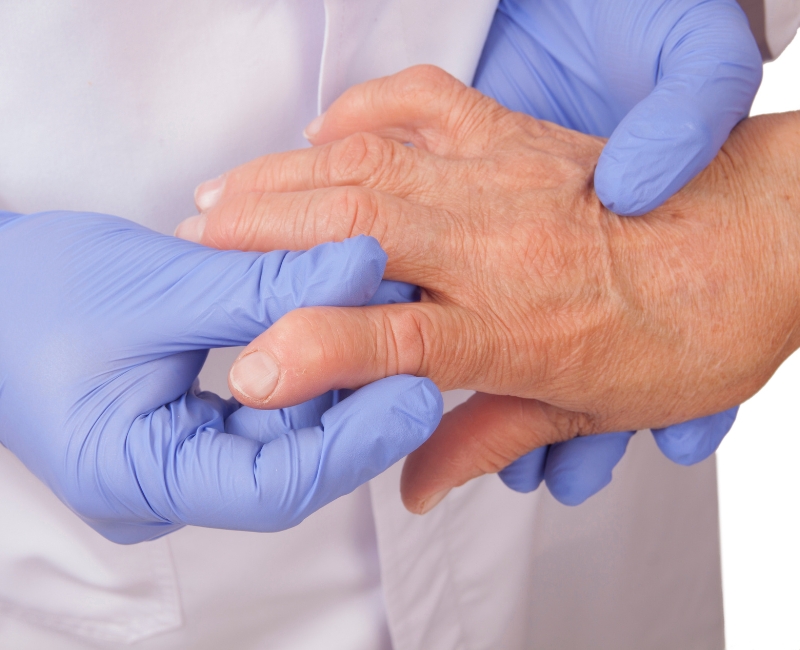 Viêm đa khớp dạng thấp ảnh hưởng đến các khớp ngón tay, chúng gây ra biến chứng làm co quắp các ngón tay