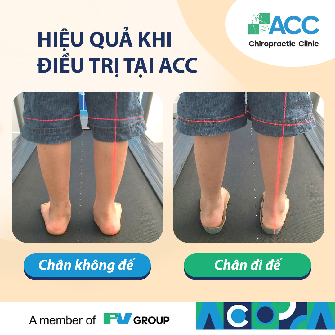 Cải thiện bàn chân bẹt khi mang đế chỉnh hình tại ACC