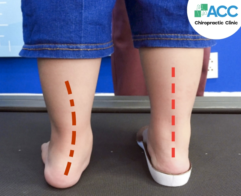Tình trạng sụp lòng bàn chân được cải thiện khi trẻ mang đế chỉnh hình