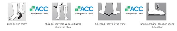 cách xác định bàn chân bẹt