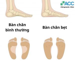 dấu hiệu nhận biết bàn chân bẹt