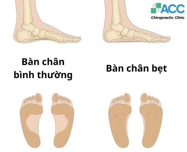 dấu hiệu nhận biết bàn chân bẹt