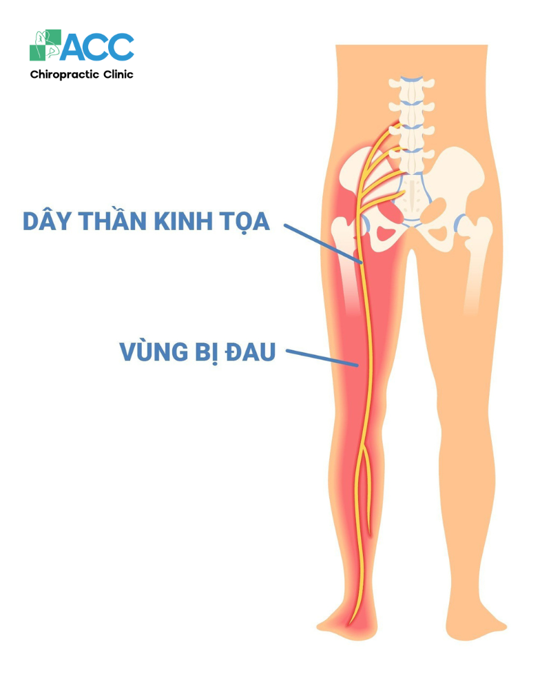 Đau thần kinh tọa là cơn đau xuất phát từ dây thần kinh ở vùng thắt lưng chạy dọc đến các ngón chân
