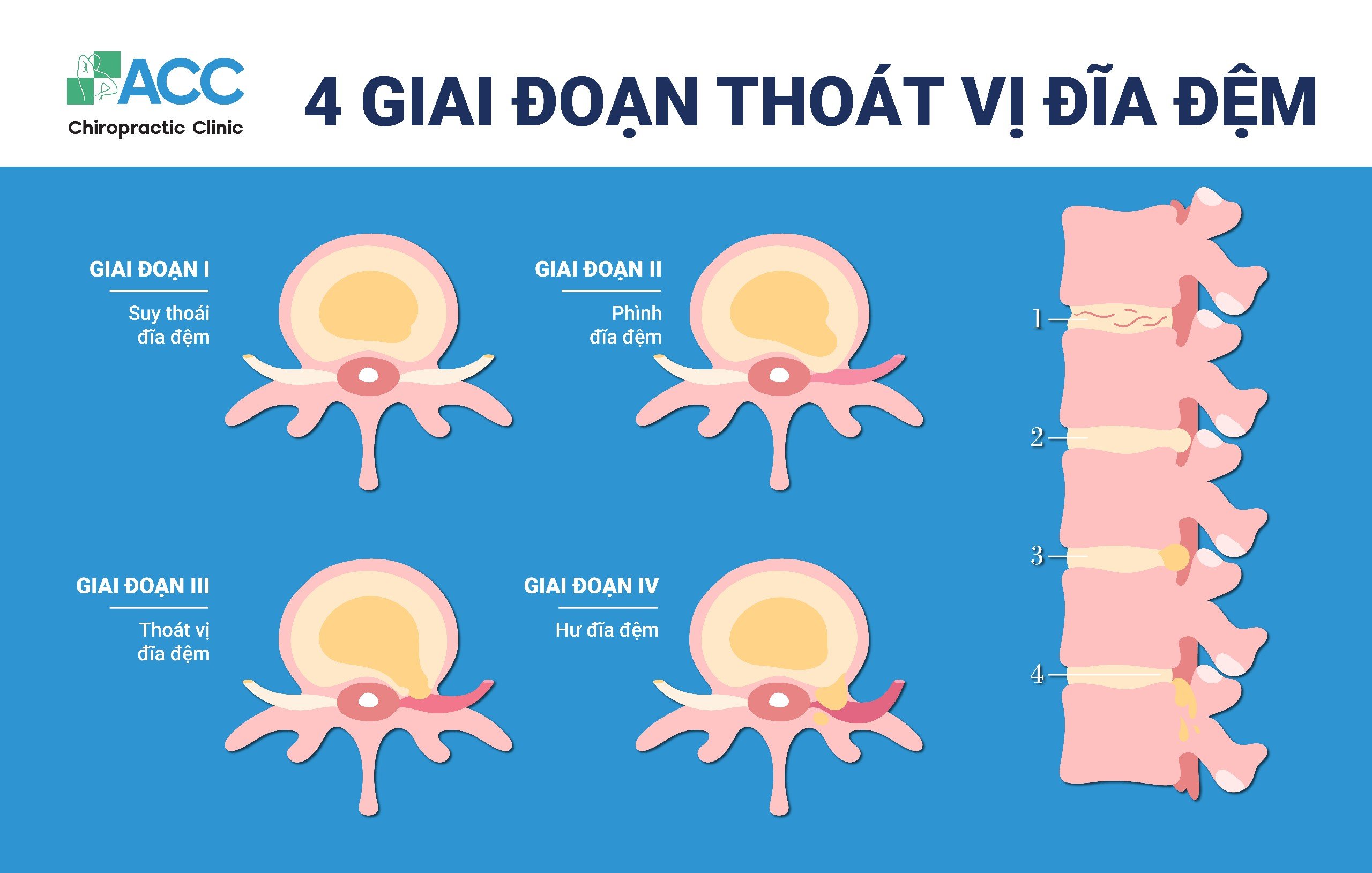 Bệnh thoát vị đĩa đệm cột sống lưng tiến triển nhanh hơn bạn nghĩ, đừng lơ là việc thăm khám sớm, lưu ý kể cả với những người trẻ