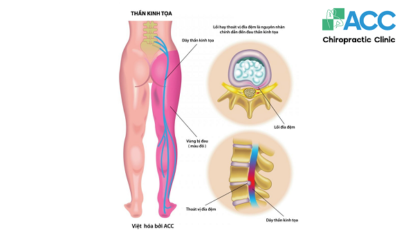 thuốc đặc trị đau dạ dày thần kinh tọa