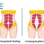 xổ bụng sau sinh