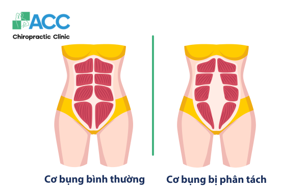 xổ bụng sau sinh