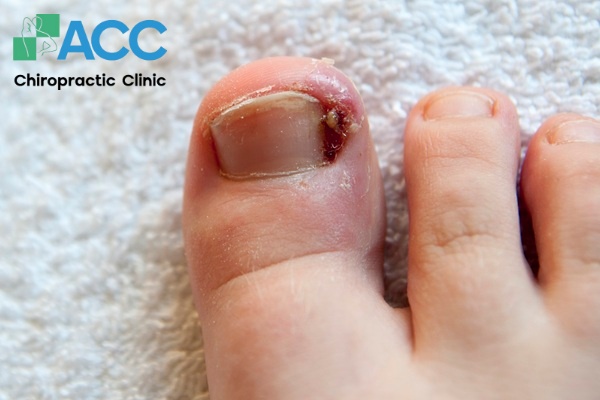 ngón chân cái bị đau nhức