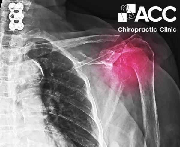 khớp vai kêu lục cục là do đâu