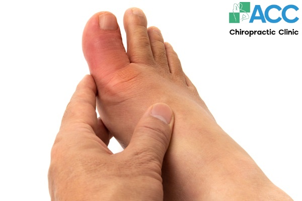 viêm khớp ngón chân cái