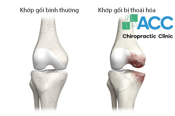thoái hoas khớp gối có nên đi bộ