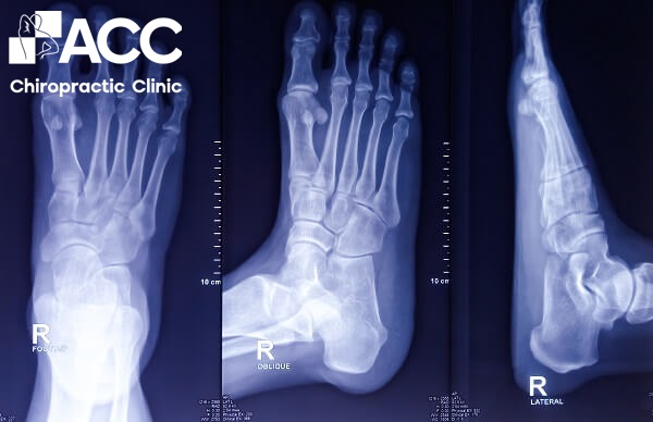 điều trị chấn thương khớp cổ chân