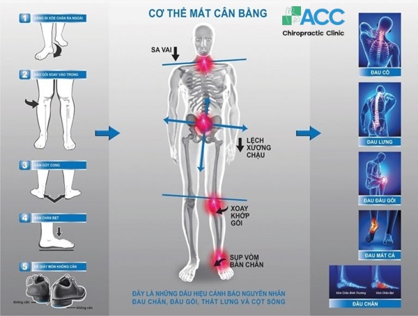 bệnh do bàn chân bẹt