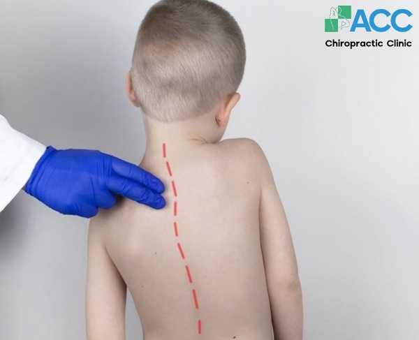 vẹo cột sống ở trẻ