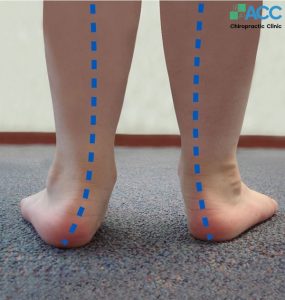 bé bị bàn chân bẹt có sao không