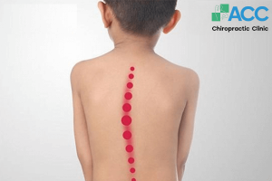 vẹo cột sống ở trẻ sơ sinh
