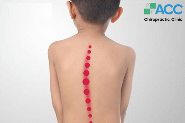 vẹo cột sống ở trẻ sơ sinh
