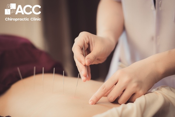phương pháp châm cứu chữa trị các bệnh liên quan đến đĩa đệm