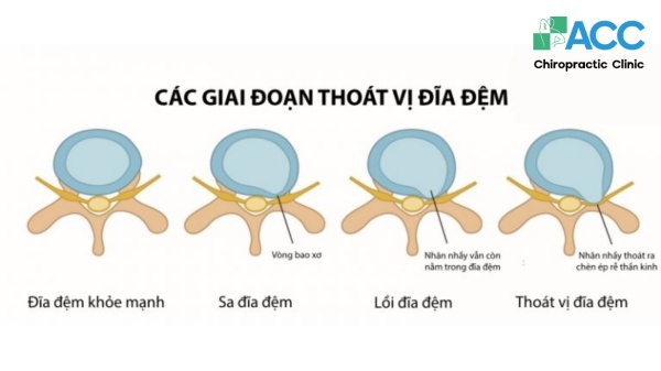 bêệnh lý thường gặp ở đĩa đệm