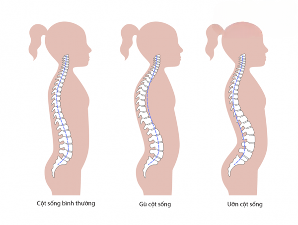 các rối loạn cột sống và dấu hiệu nhận biết