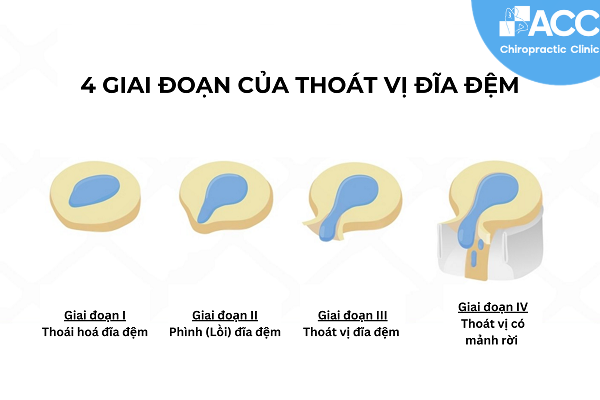 khám thoast vị đĩa đệm ở đâu