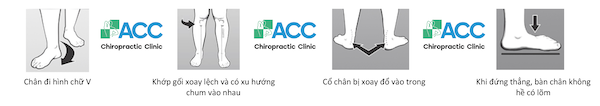dấu hiệu bàn chân bẹt ở trẻ