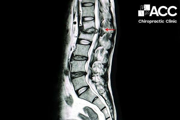 nhói sau lưng là bệnh gì