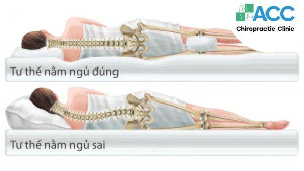 cẩn trọng tư thế sinh hoạt tránh thoát vị đĩa đệm