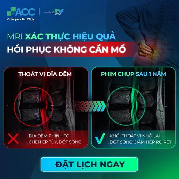 điều trị thoát vị đĩa đệm