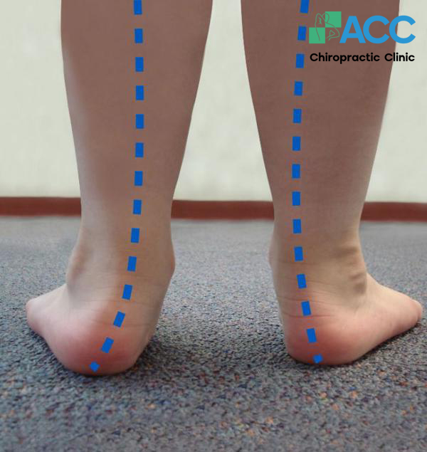 hội chứng bàn chân bẹt là gì