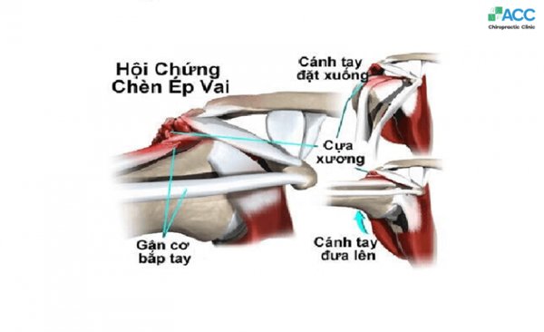 khớp vai bị đau